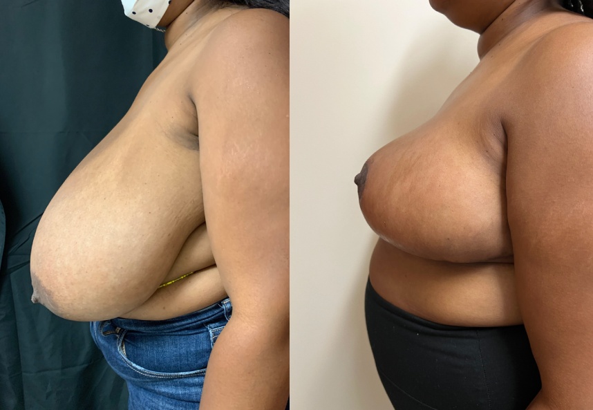 before and after breast reduction Dr. Sabry left side view case 29453