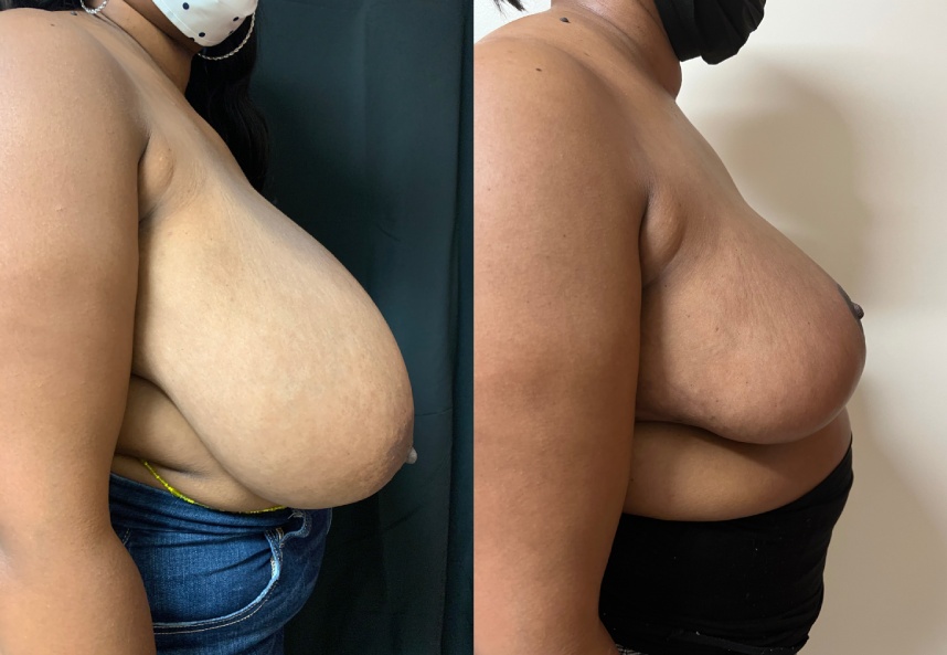 before and after breast reduction Dr. Sabry right side view case 29453