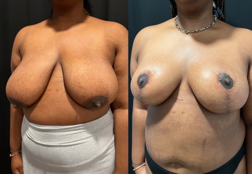 before and after breast reduction Dr. Sabry left angle view female patient case 29461