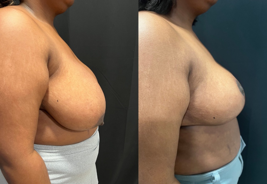 before and after breast reduction Dr. Sabry right side view female patient case 29461