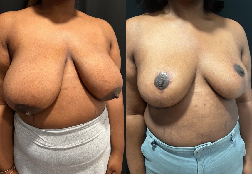 before and after breast reduction Dr. Sabry right angle view female patient case 29461