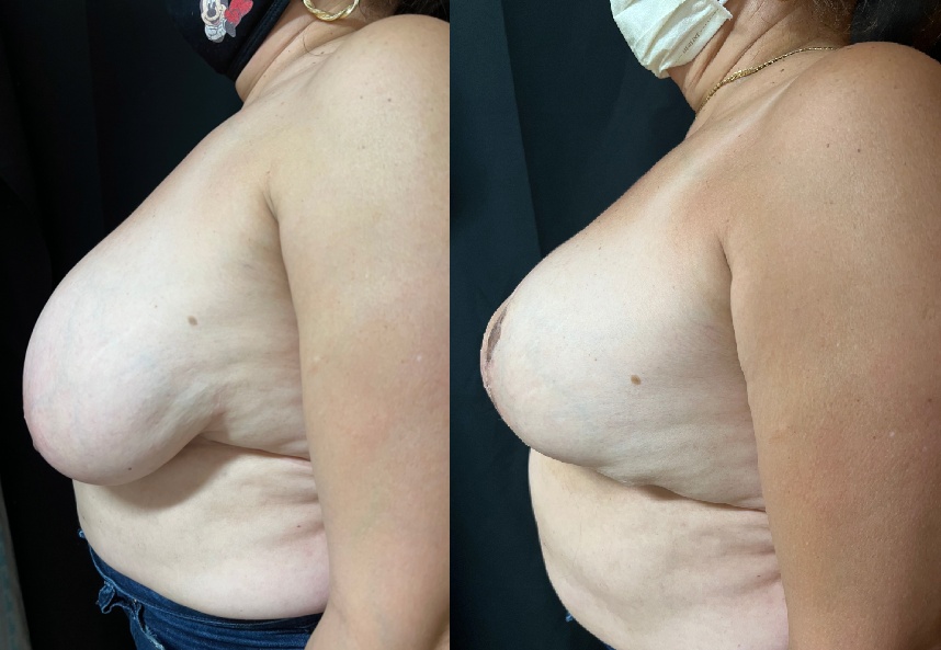 before and after breast reduction left side view female patient case 29488