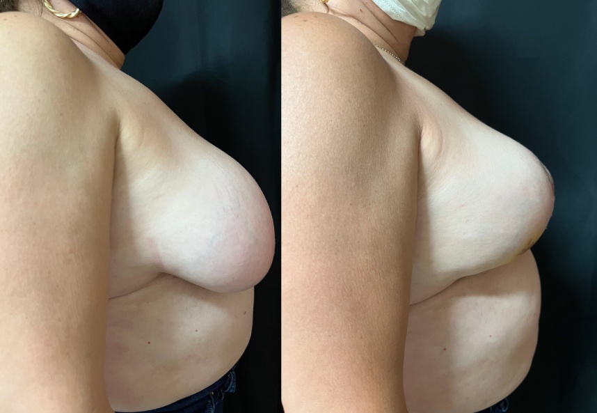 before and after breast reduction right side view female patient case 29488