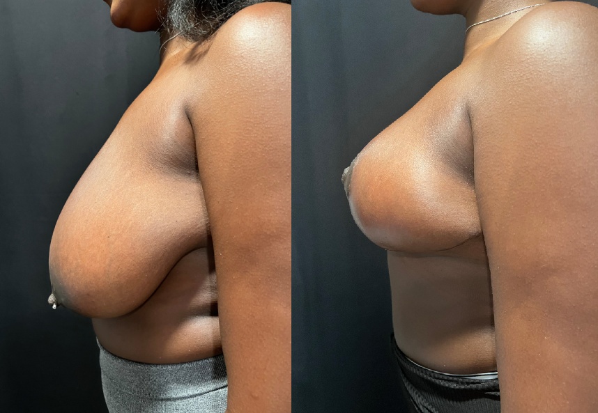 before and after breast reduction left side view female patient case 29496