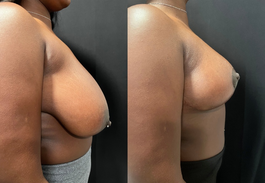 before and after breast reduction side view female patient case 29496