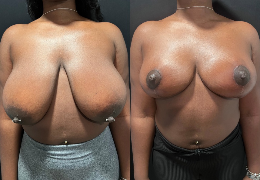 before and after breast reduction front view female patient case 29496