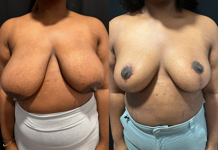before and after breast reduction Dr. Sabry front view female patient case 29461