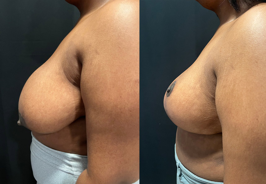 before and after breast reduction Dr. Sabry left side view female patient case 29461