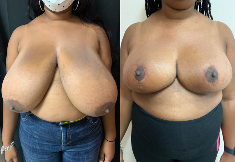 before and after breast reduction Dr. Sabry front view case 29453