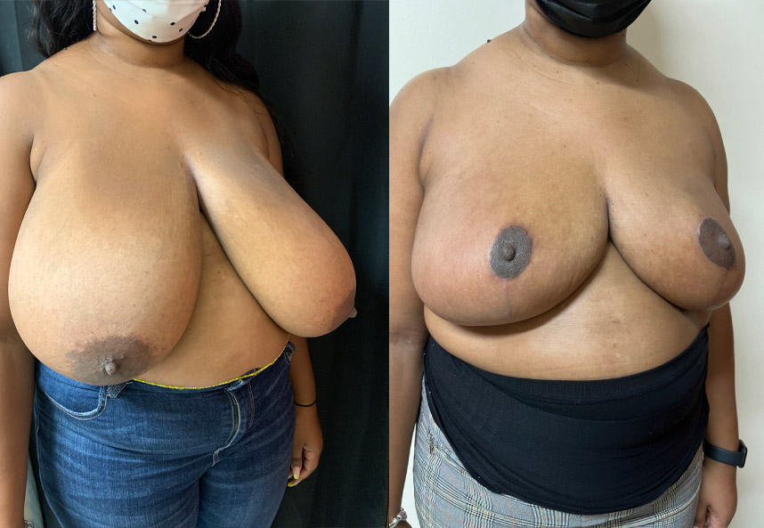 before and after breast reduction Dr. Sabry right angle view case 29453