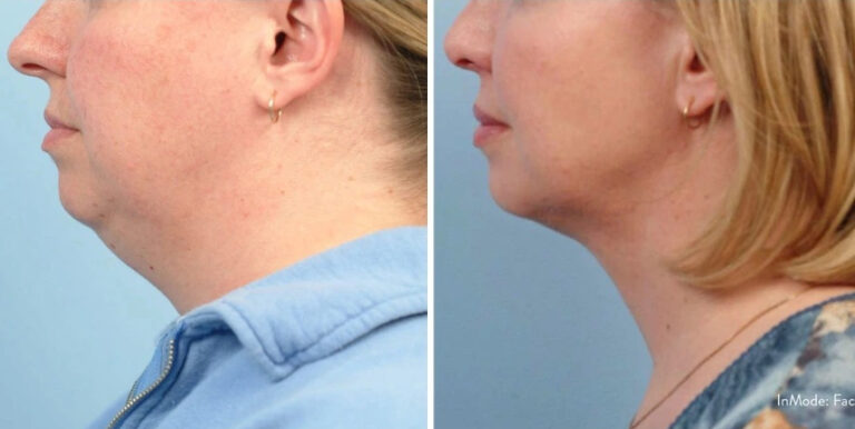before and after accutite neck slimming female patient case 28857