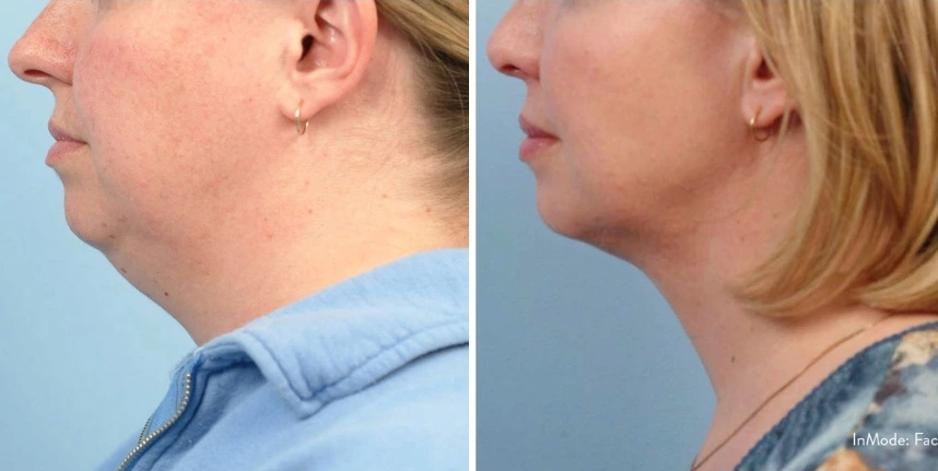 before and after accutite neck slimming female patient case 28857