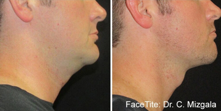 before and after accutite for neck slimming case 28859