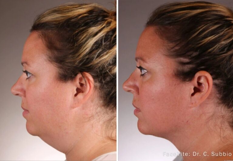 before and after accutite side neck view case 28861