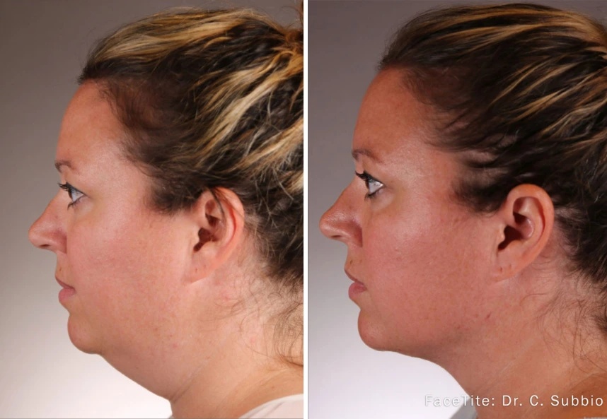 before and after accutite side neck view case 28861
