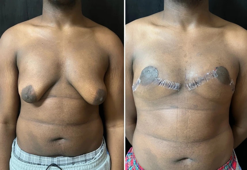 before and after gynecomastia procedure front view case 28871