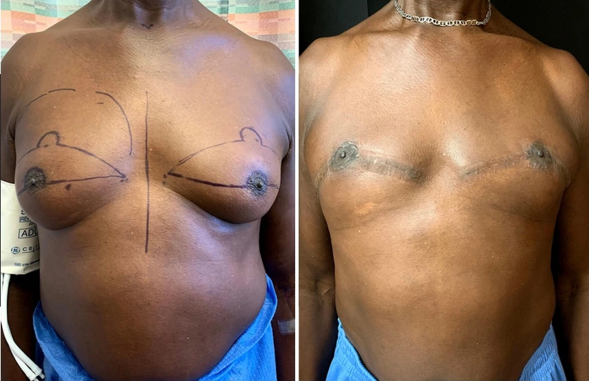before and after gynecomastia procedure front view case 28873