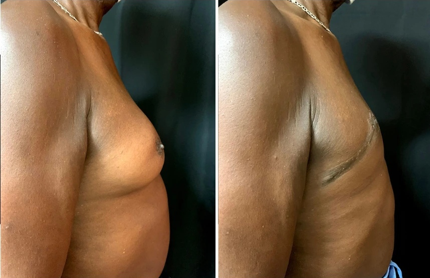 before and after gynecomastia procedure right side view case 28873