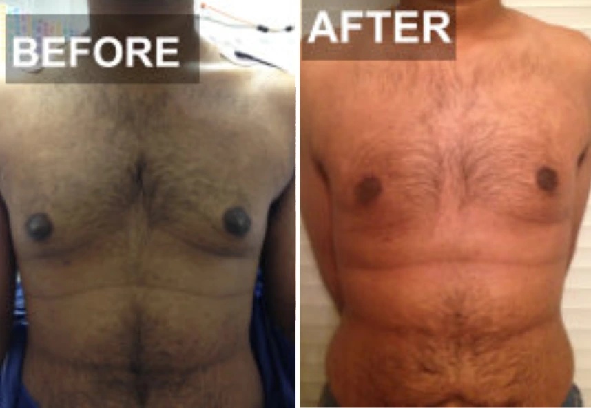 before and after gynecomastia procedure front view case 28880