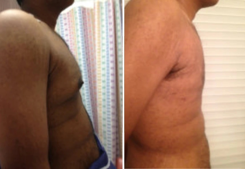 before and after gynecomastia procedure right side view case 28880
