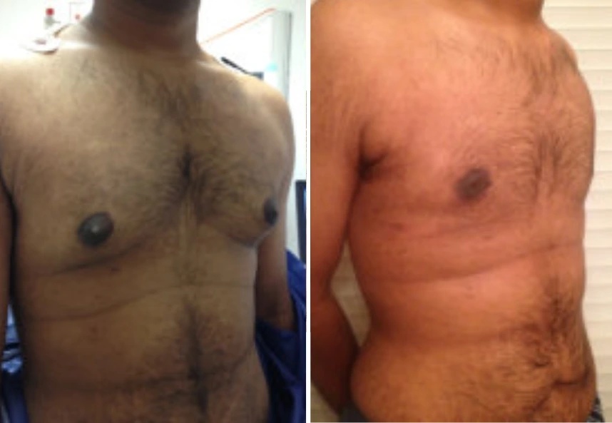 before and after gynecomastia procedure right angle view case 28880