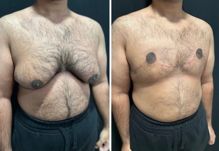 before and after gynecomastia procedure front view case 28884