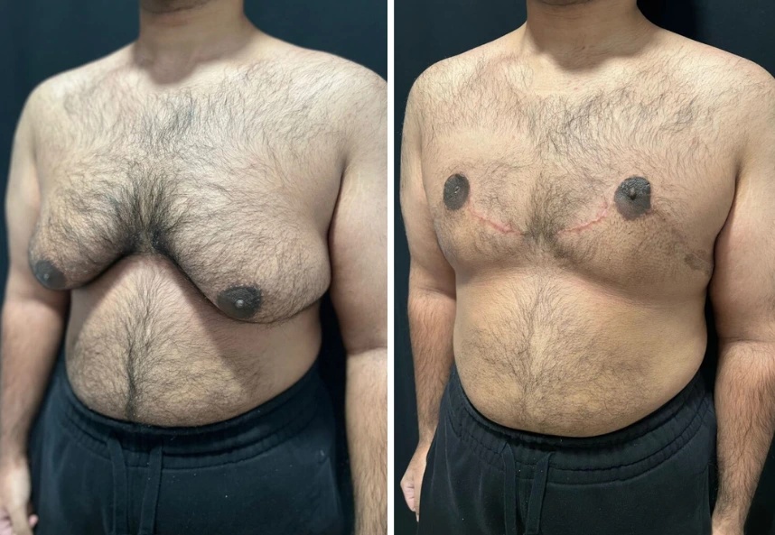 before and after gynecomastia procedure left angle view case 28884