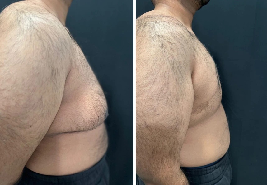 before and after gynecomastia procedure right side view case 28884