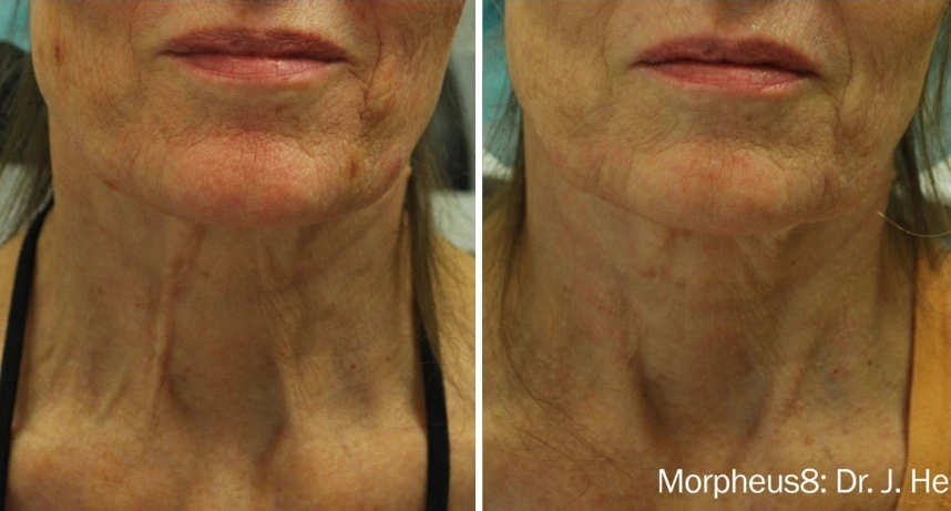 before and after Morpheus8 neck view case 28848