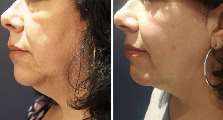 before and after Morpheus8 neck view case 28853