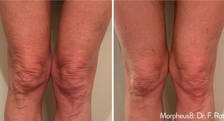 before and after Morpheus8 thigh view case 28853