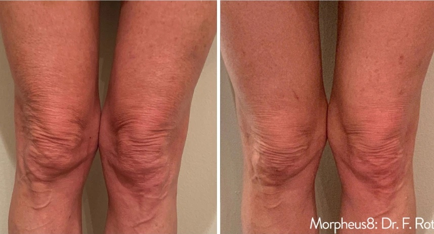 before and after Morpheus8 thigh view case 28853