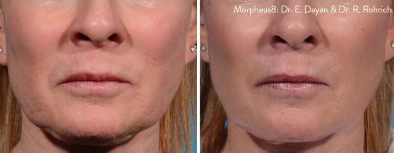 before and after Morpheus8 front view case 28855