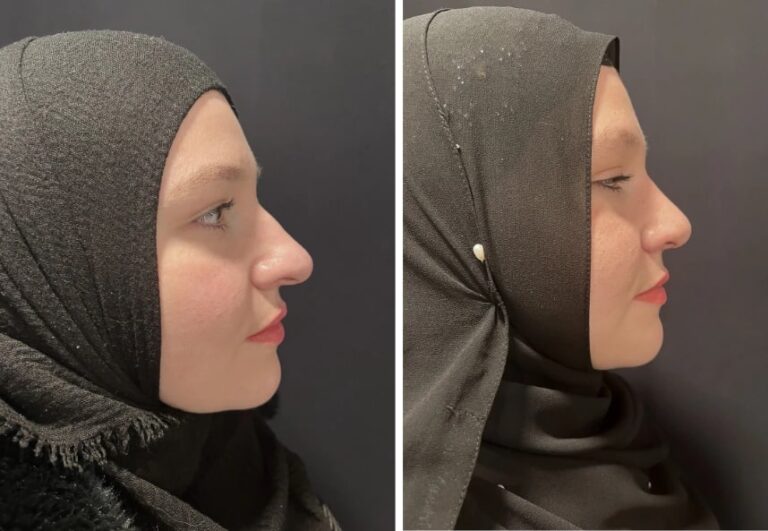 before and after rhinoplasty front view view case 28889