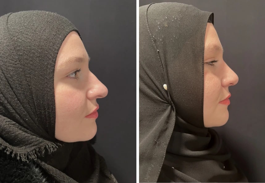 before and after rhinoplasty front view view case 28889