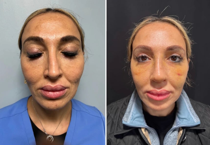 before and after rhinoplasty front view case 28891