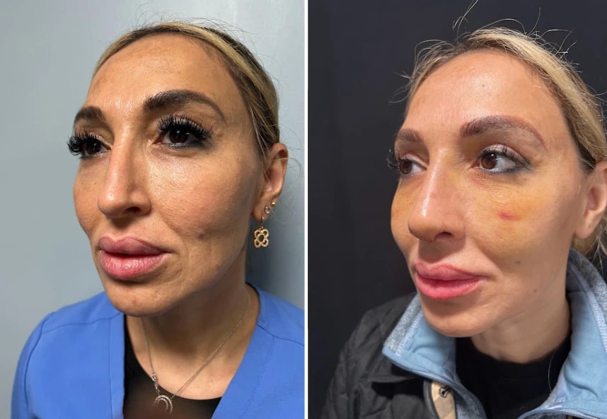 before and after rhinoplasty left angle view case 28891