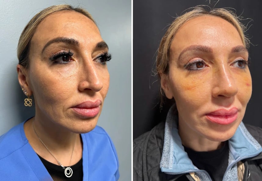 before and after rhinoplasty right angle view case 28891