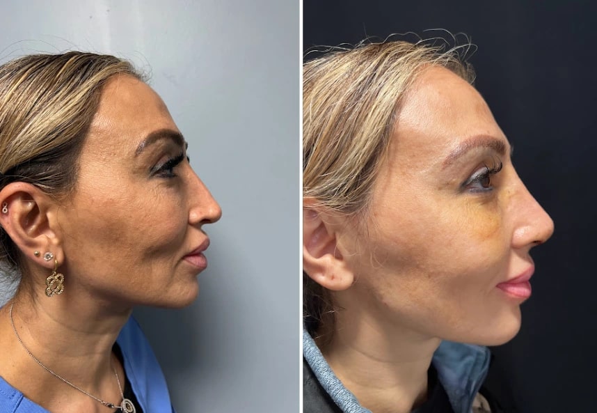 before and after rhinoplasty right side view case 28891