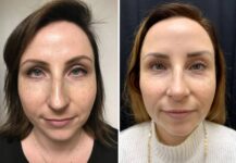 before and after rhinoplasty front view case 28903