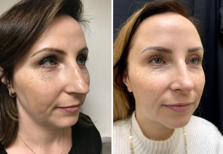 before and after rhinoplasty right angle view case 28903