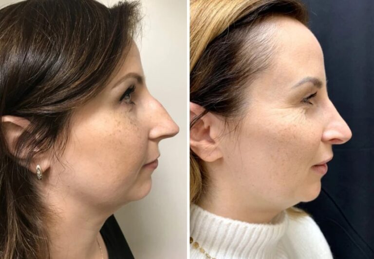 before and after rhinoplasty right side view case 28903