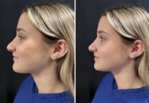 before and after rhinoplasty left side view case 28909