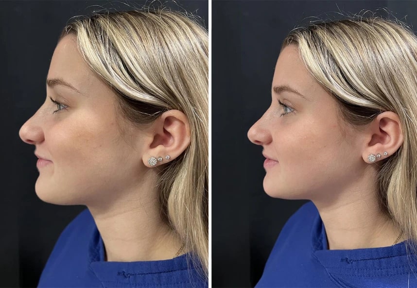 before and after rhinoplasty left side view case 28909
