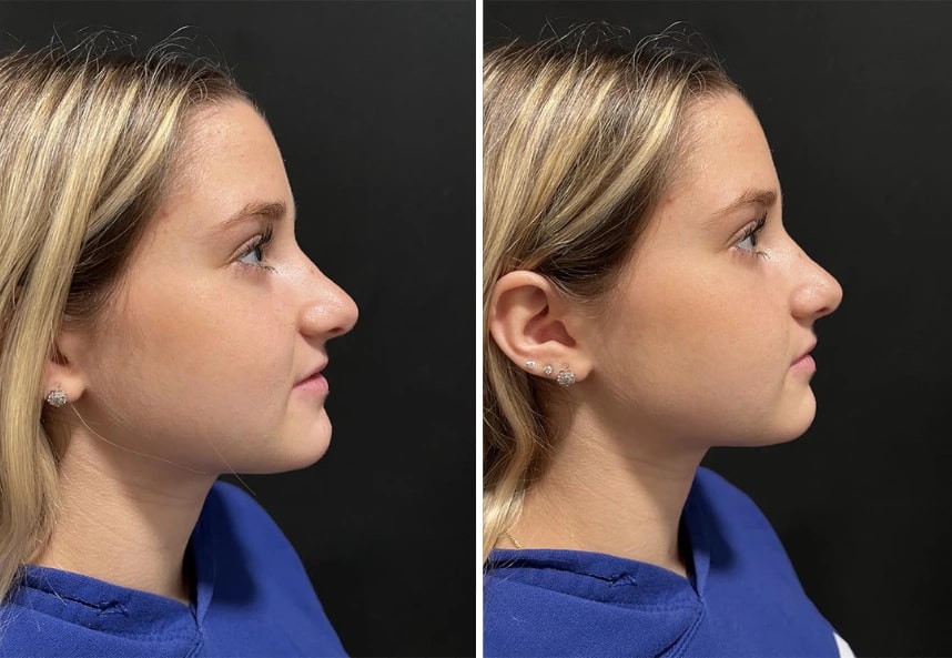 before and after rhinoplasty right side view case 28909