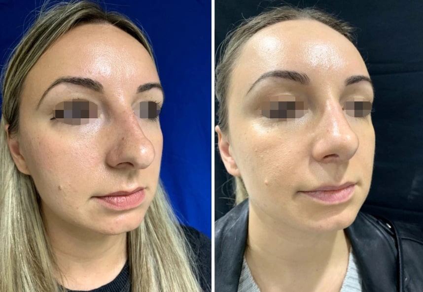 before and after rhinoplasty Murray Hill Plastic Surgery right angle view case 28912