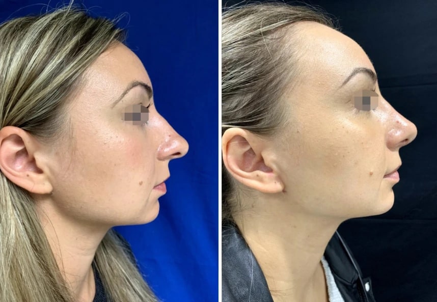 before and after rhinoplasty Murray Hill Plastic Surgery right side view case 28912