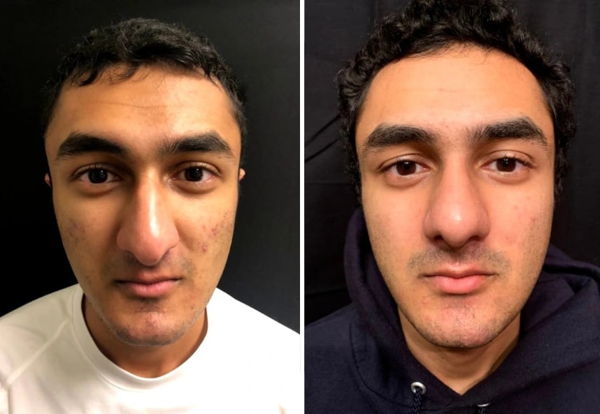 before and after rhinoplasty Murray Hill Plastic Surgery front view case 28915