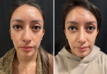 before and after female rhinoplasty Murray Hill Plastic Surgery front view case 28919