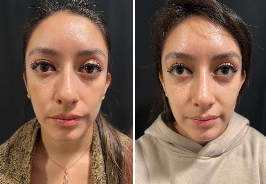 before and after female rhinoplasty Murray Hill Plastic Surgery front view case 28919